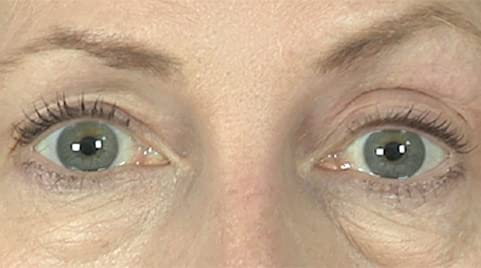Butterfly Invisible Double Eye Lift