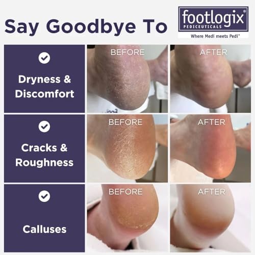 Foot Care Callus Softener - Footlogix Callus Softener Spray & Double Sided Foot File Set for Dry, Rough, Cracked Heel - Feet Exfoliator & Scrubber