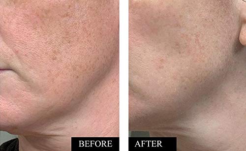 Vitamin C Serum for Face | Brightening & Anti Aging Serum for Men & Women | With Hyaluronic Acid, Vitamin E, Aloe & Jojoba | Dark Spot & Wrinkle