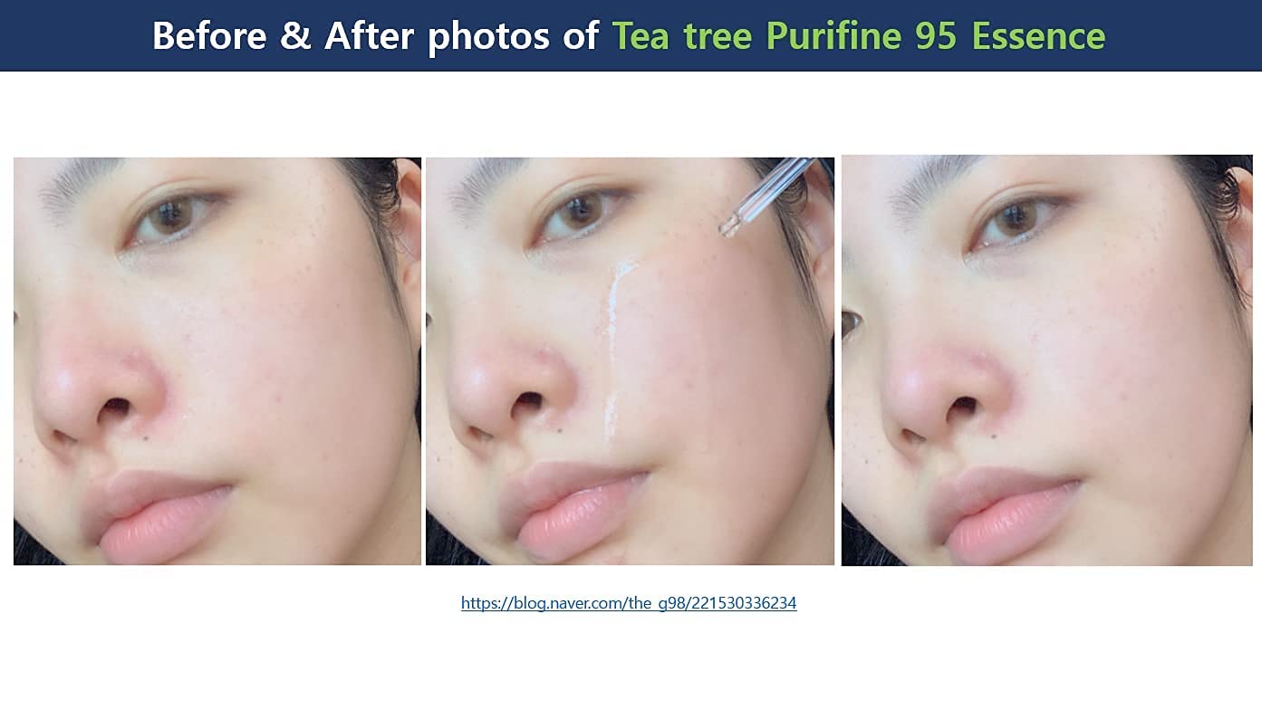 Dr.Ceuracle Tea Tree Purifine Essence - Mild Facial Serum for Sensitive Skin, Redness and Sebum Reducing Korean Skin Care (50ml / 1.69 fl. oz.) Beauty & Personal Care leegeehaam
