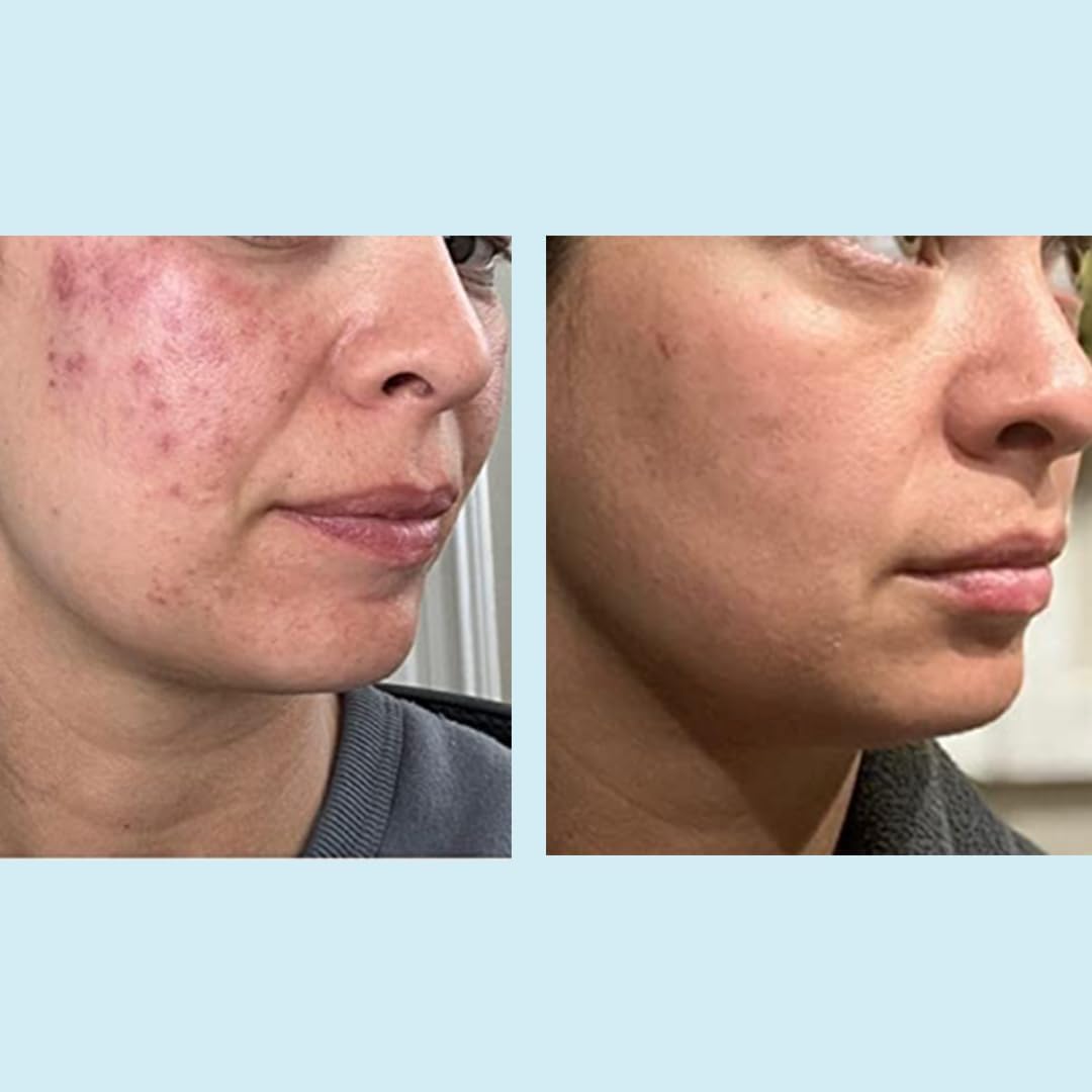 Glycolic Gel Peel - Enhanced with Retinol and Green Tea Extract (70% Strength)