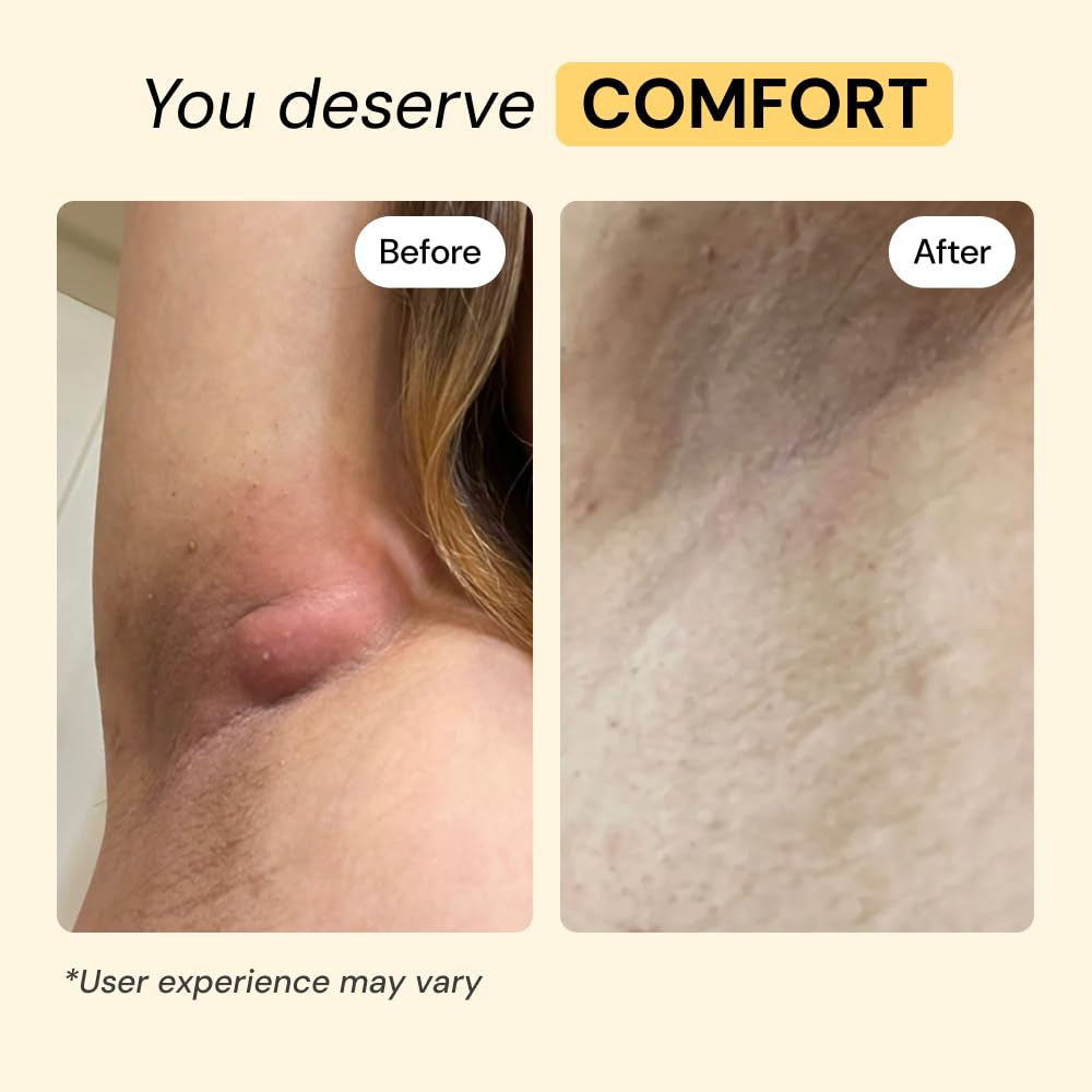 MyMagicHealer Universal Flare Care - Solution for Everyday Skin Flare-Ups | Drawing Salve for Boils & Cysts, Hidradenitis Suppurativa, Folliculitis | Beauty and Personal Care MyMagicHealer