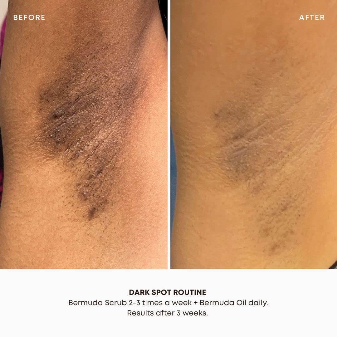 Bushbalm Dark Spots and Ingrown Hair 2 Step Routine - Rejuvenate and Nourish - Ingrown Hair Oil (30 ml) and Exfoliating Scrub (236 ml) - Bermuda