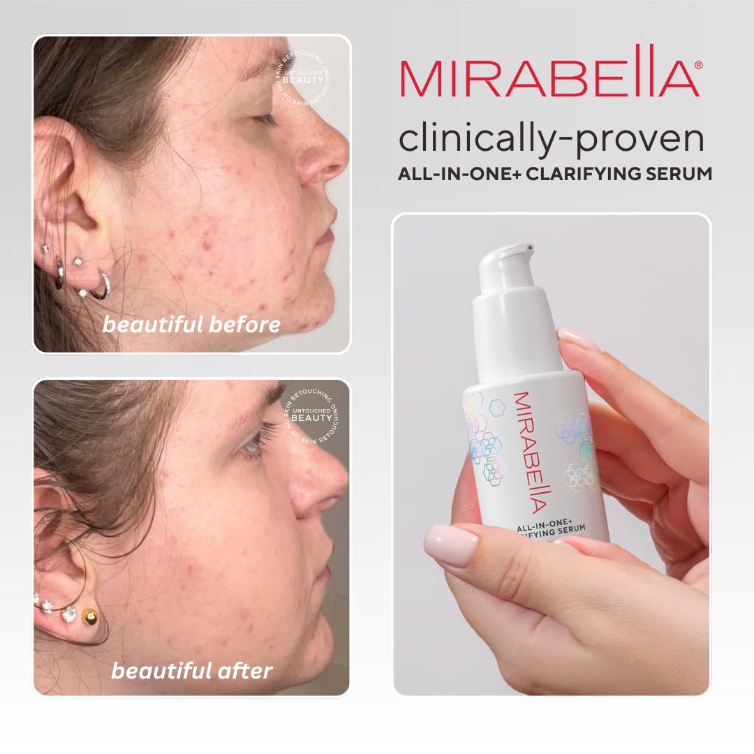 Mirabella All In One Clarifying Serum Micro Peel for Anti Aging - Hydrating 7% Glycolic Acid & 8.8% Lactic Acid Serum Face Peel with AHA BHA