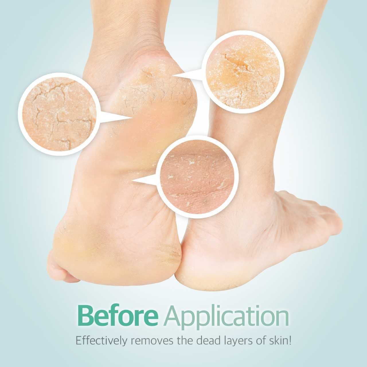 Foxi Fresh 2-Sided Diamond Coated Foot Scrubber Callus Remover Foot File Foot Care