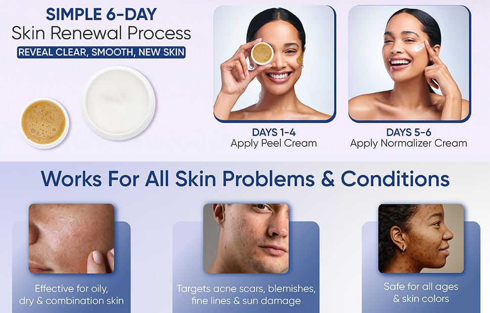 SKIN PEEL 4000 - Chemical Skin Peel Kit | Created in1937 | Gets rid of acne scars, blemishes, large pores, fine lines, sun damage in only 6 days!