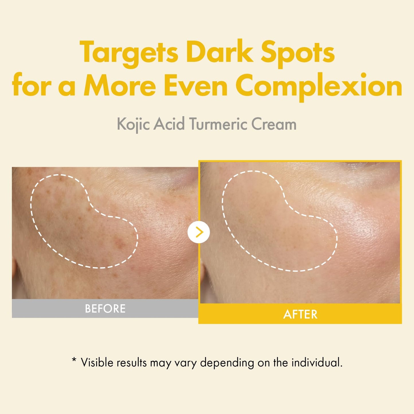TOSOWOONG Kojic Acid Turmeric Cream, 99% Purity Kojic Acid 7,000ppm, 660,941ppm Turmeric, Dark Spot Corrector Capsule for Hyperpigmentation & Even Beauty and Personal Care TOSOWOONG