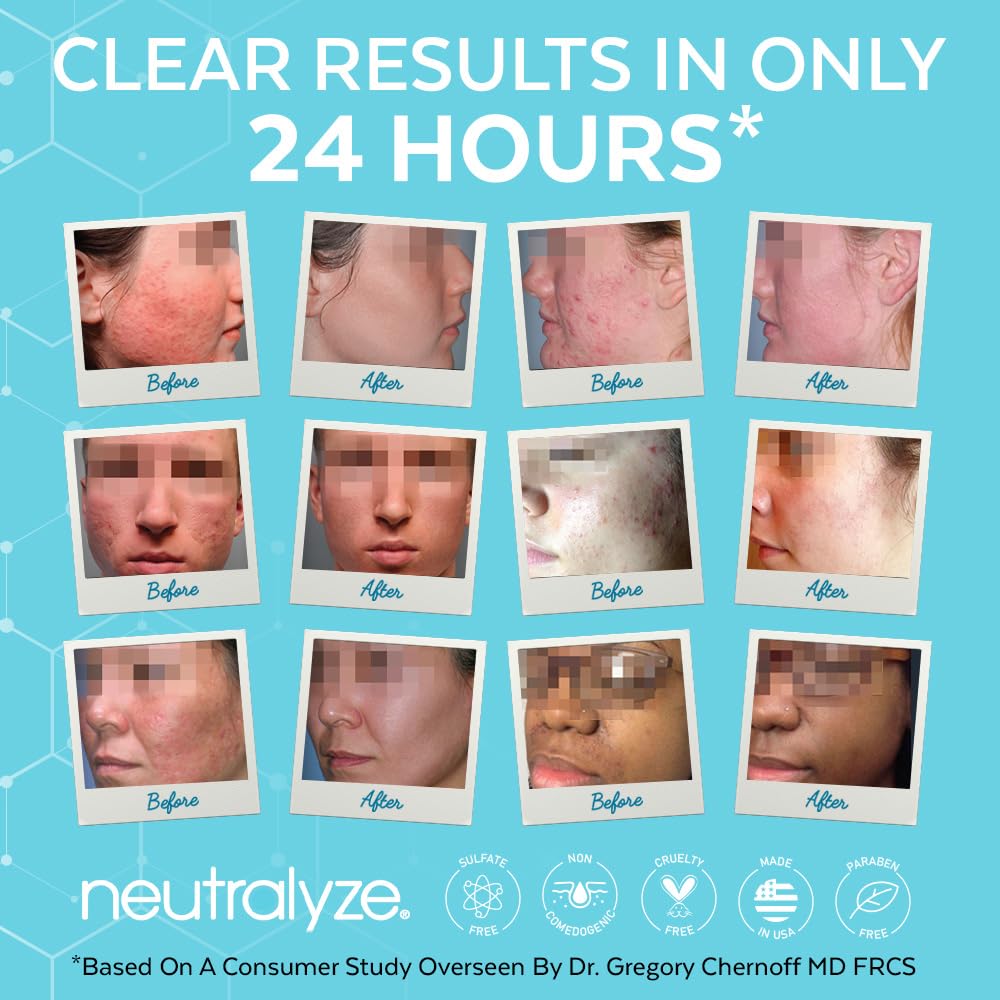 Neutralyze Acne Wash for Face with 2% Mandelic Acid & 2% Salicylic Acid - Professional Grade, A.H.A. + B.H.A. Facial Cleanser for Acne Prone Skin (90+
