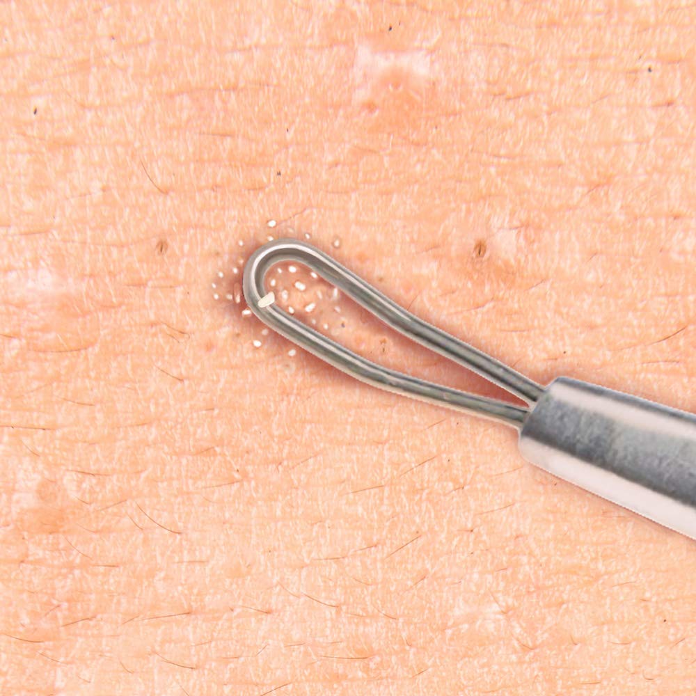 Beaute Galleria Double Loop Blackhead Remover Pimple Extractor Popper for Acne Comedone Blemish Whitehead Zit Removal Tool
