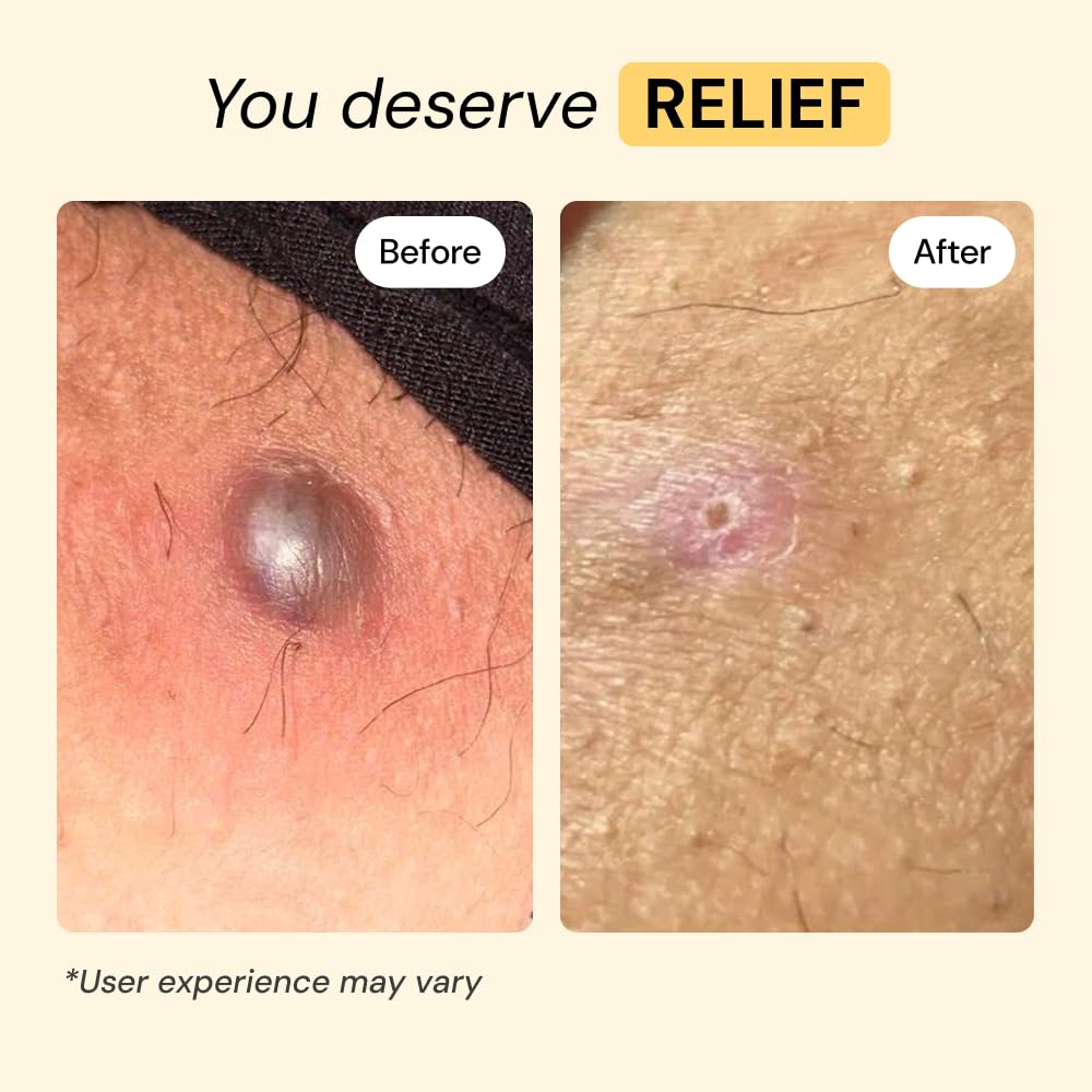 MyMagicHealer Universal Flare Care - Solution for Everyday Skin Flare-Ups | Drawing Salve for Boils & Cysts, Hidradenitis Suppurativa, Folliculitis | Beauty and Personal Care MyMagicHealer