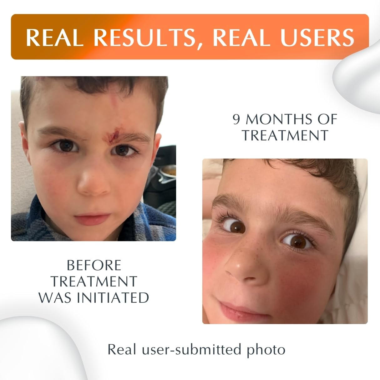 MyNewGel Plus UV Silicone Scar Gel with SPF 30 – Mineral Non-Chemical Sunscreen for Old & New Scars, Protects Against Harmful UV Rays, 15g