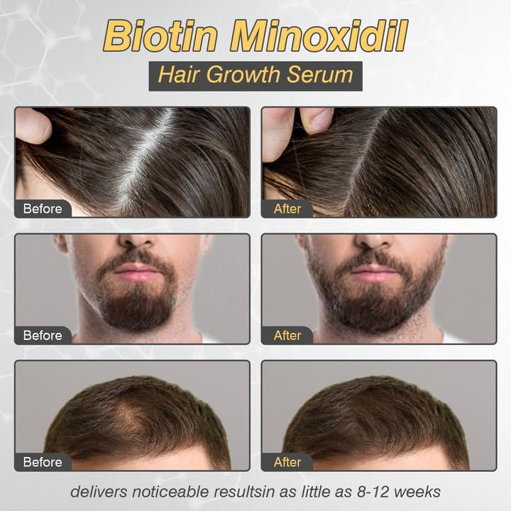 5% Minoxidil Hair Growth for Men and Women, Minoxidil Hair Growth Serum, Promotes Hair Growth, Strengthens Hair Follicles, Helps Prevent Hair Fall Beauty and Personal Care YKDILYHH