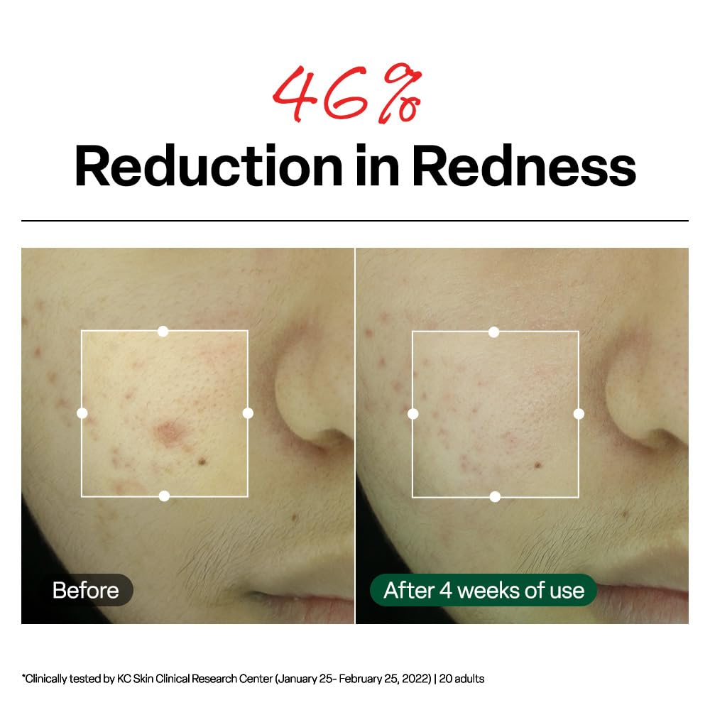 Dr. G R.E.D. Blemish Clear Soothing Cream - Calming Korean Moisturizer for Redness - Soothes Acne & Irritation - With Centella Asiatica - Long-Lasting