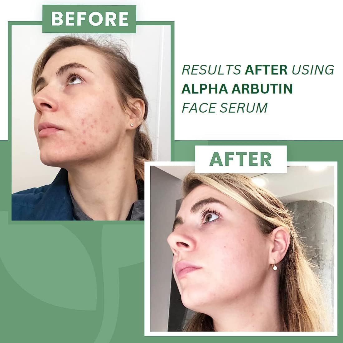 OTAA 2% Alpha Arbutin Serum for Pigmentation & Dark Spots Removal - Anti-pigmentation Face Serum For Men & Women with Hyaluronic Acid to Remove