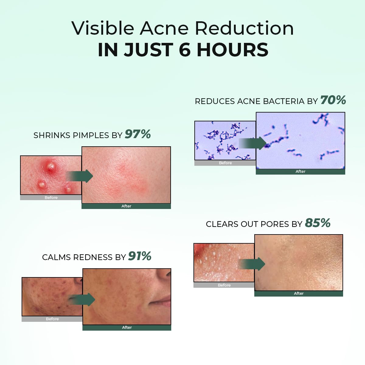Acne Spot Corrector Gel Serum
