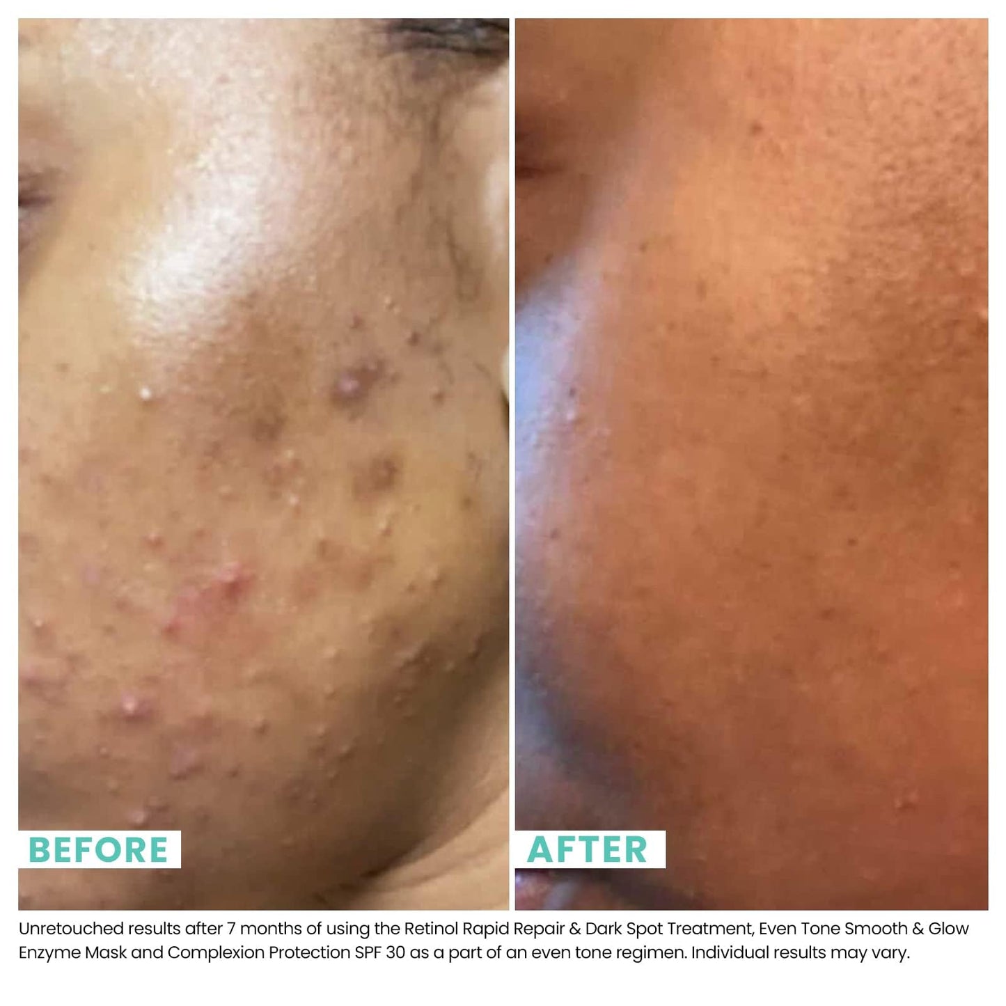 Urban Skin Rx Even Tone Smooth & Glow Enzyme Mask 1.7 oz – Exfoliates, Brightens & Evens Skin with Glycolic Acid, Lactic Acid & Vitamin C