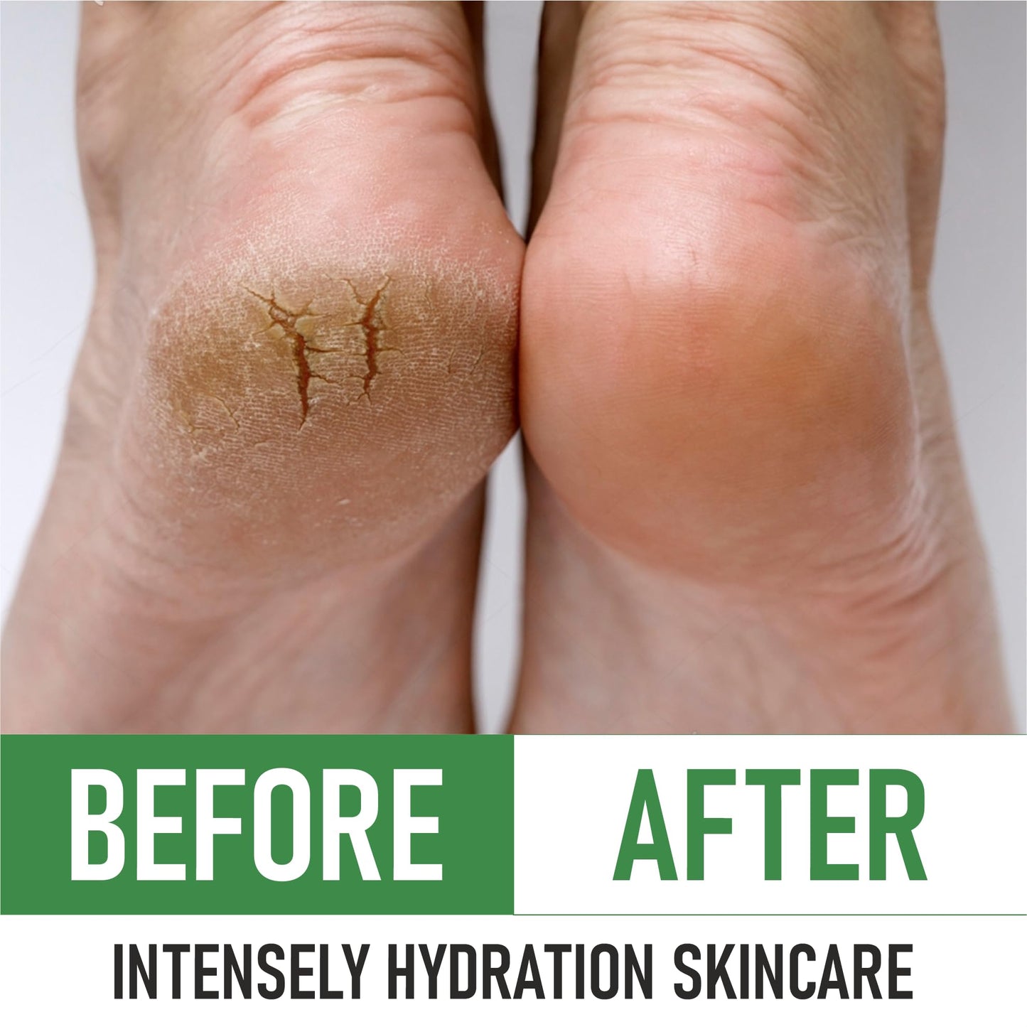 PurOrganica Urea 40% Foot Cream – Dermatologist Tested, Made in USA, Repairs Cracked Heels, Calluses & Corns, Exfoliating & Moisturizing