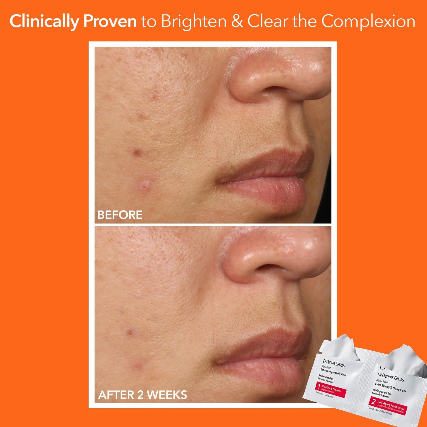 Dr. Dennis Gross Alpha Beta Extra Strength Daily Peel: for Oily Skin, Uneven Tone or Texture, Wrinkles or Enlarged Pores (30 Treatments)