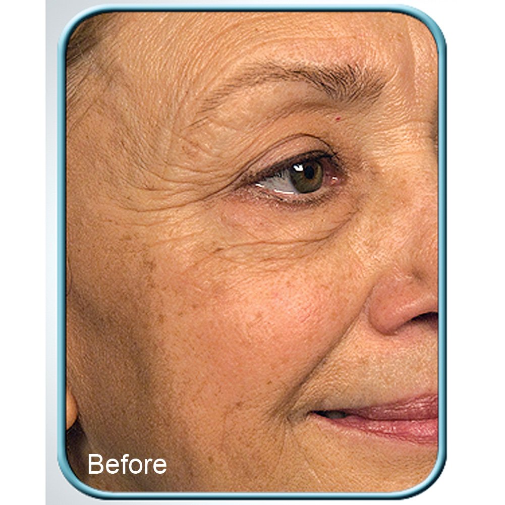 Biologic Stem Cell Therapy (Set of 4 Jars) for Deep Wrinkles - by BioLogic