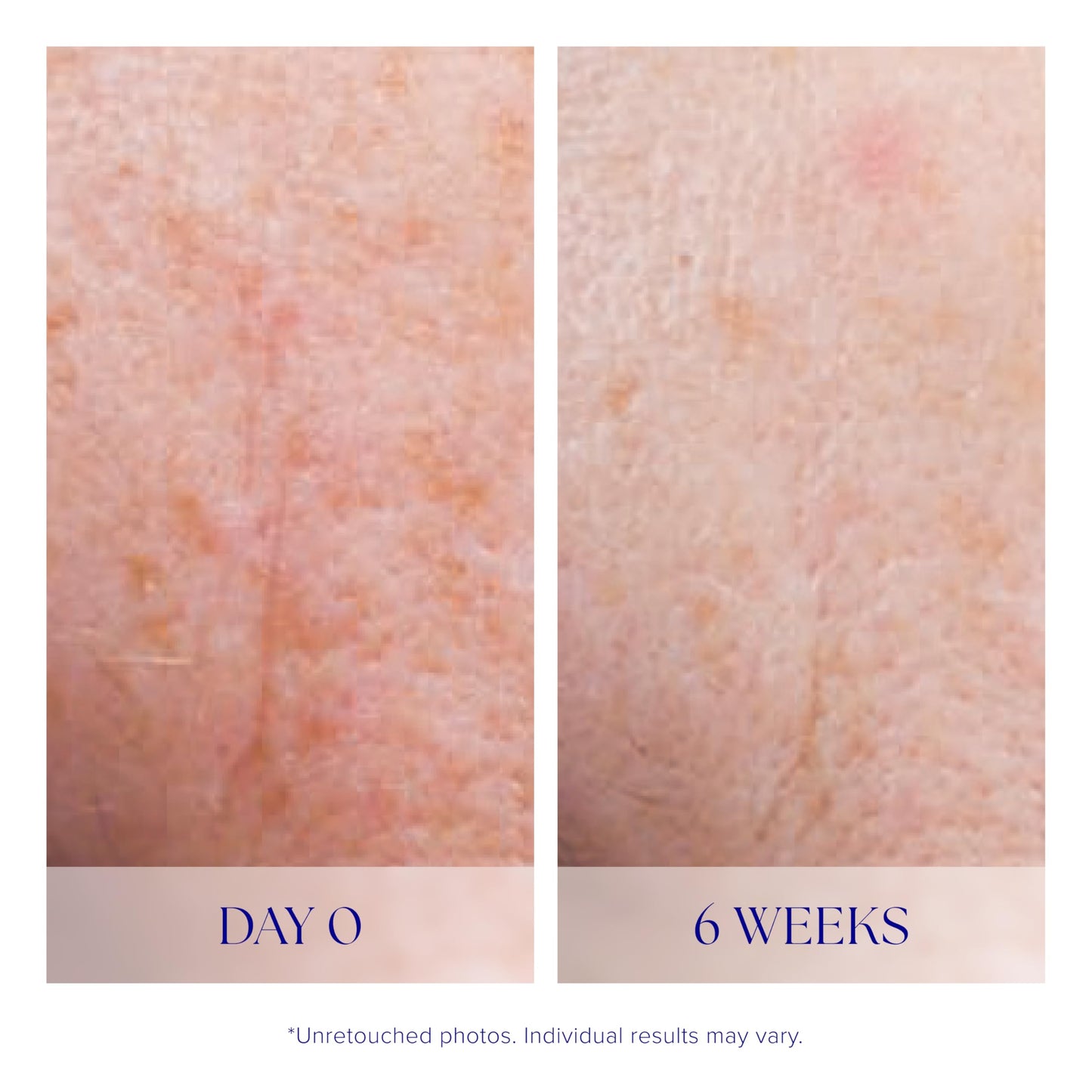 iS CLINICAL Active Serum - Helps visibly even skin tone, Excellent for acne-prone skin, Anti-Aging, Face Serum, 1 Fl Oz