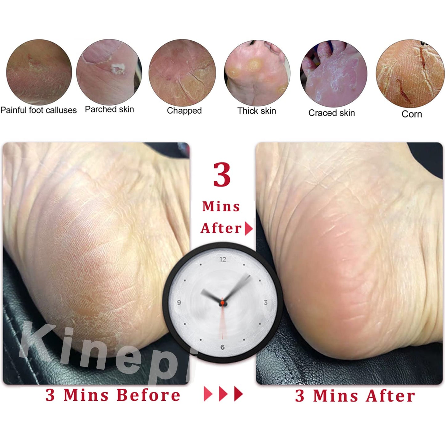 Kinepi Callus Remover Foot Scrubber Colossal Foot File Foot Care and Foot Exfoliator Foot Rasp Pedicure Tools Pumice Stone for Feet,Remove Corn Hard