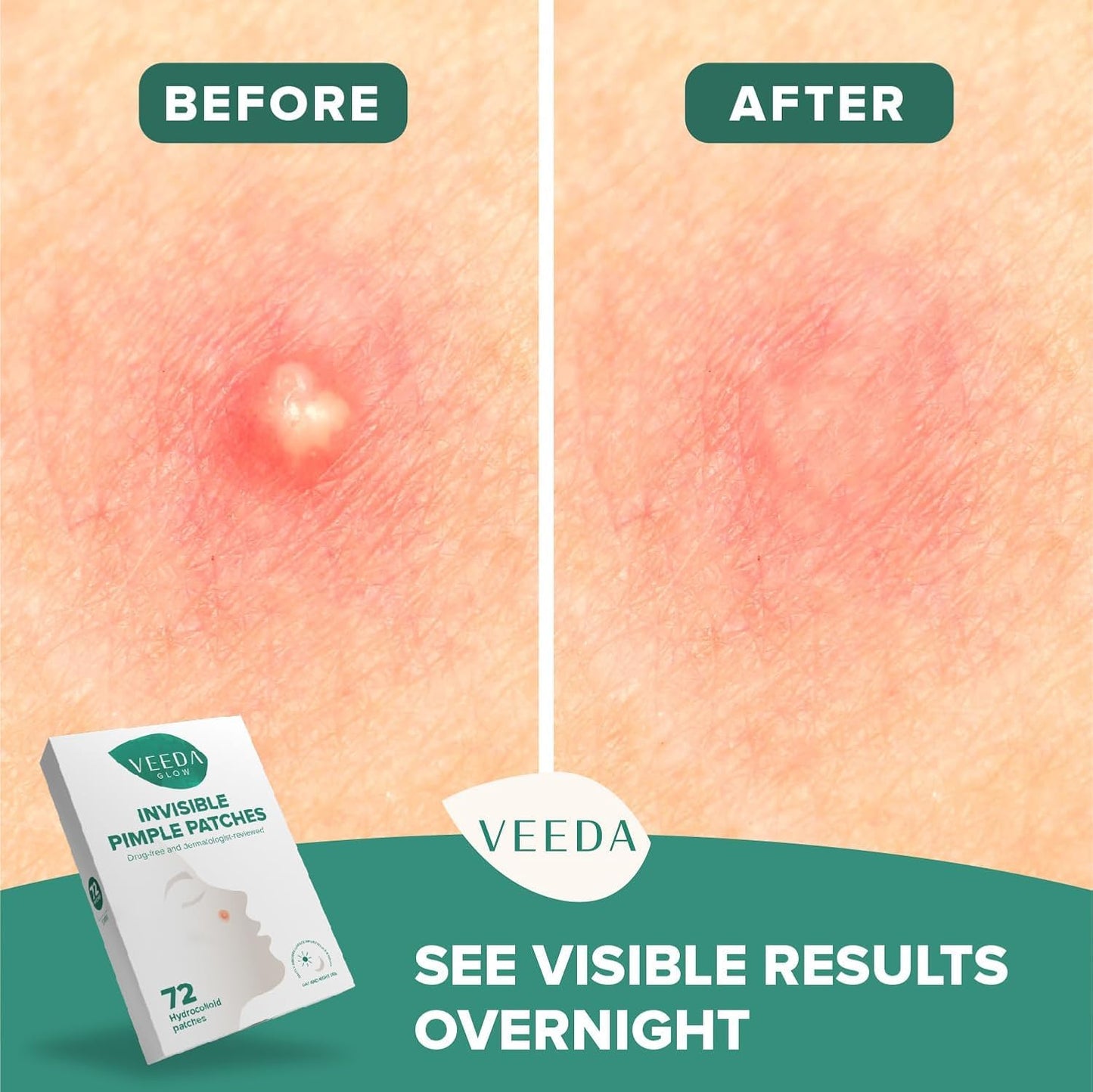 Veeda Glow Pimple Patches - Hydrocolloid Acne Stickers for Fast Healing, Invisible & Non-Irritating Zit Covers, Blemish Spot Treatment, 72 Count