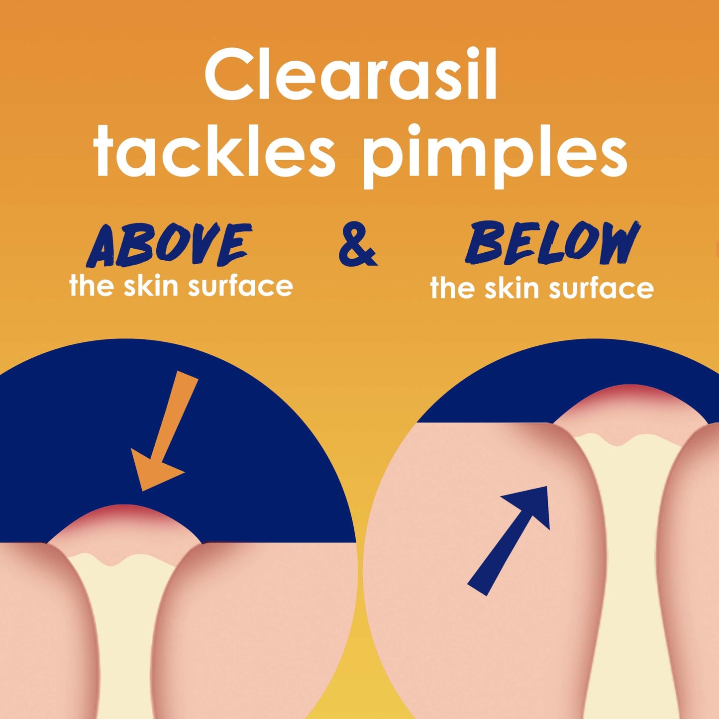 Clearasil Stubborn Acne Control 5in1 Exfoliating Wash, Maximum Strenght with 2% Salicylic Acid Acne Treatment Medicine, Daily Acne Facial Cleanser