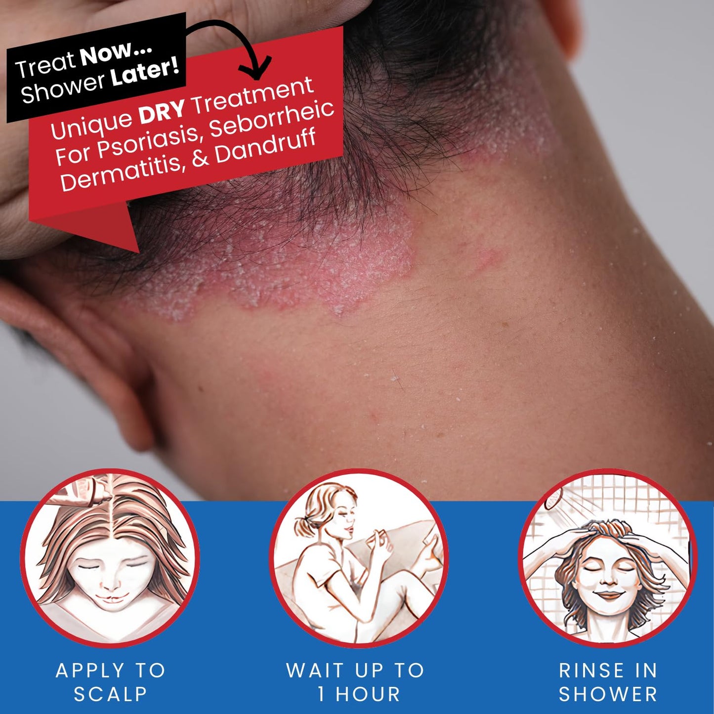 Tarsum Extra Strength Psoriasis Shampoo - Coal Tar Shampoo and Conditioner for Scalp Psoriasis, Seborrheic Dermatitis, Severe Dandruff, & Eczema