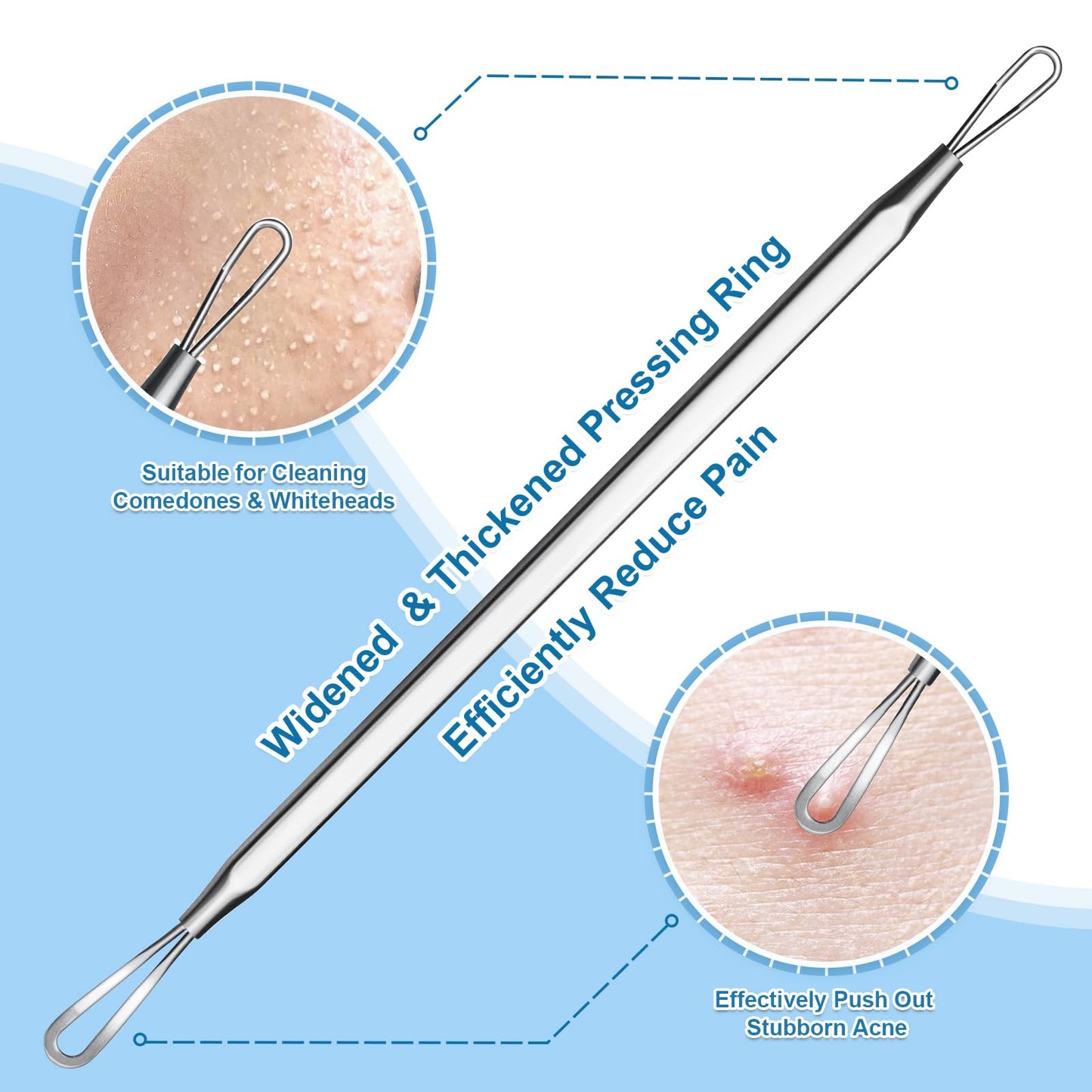 Vybiekr Stainless Steel Blackhead Remover, Pimple Extractor, Pimple Popper, Comedone Extractor, Surgical Grade Acne Treatment Tool, 3rd Generation Beauty and Personal Care Vybiekr