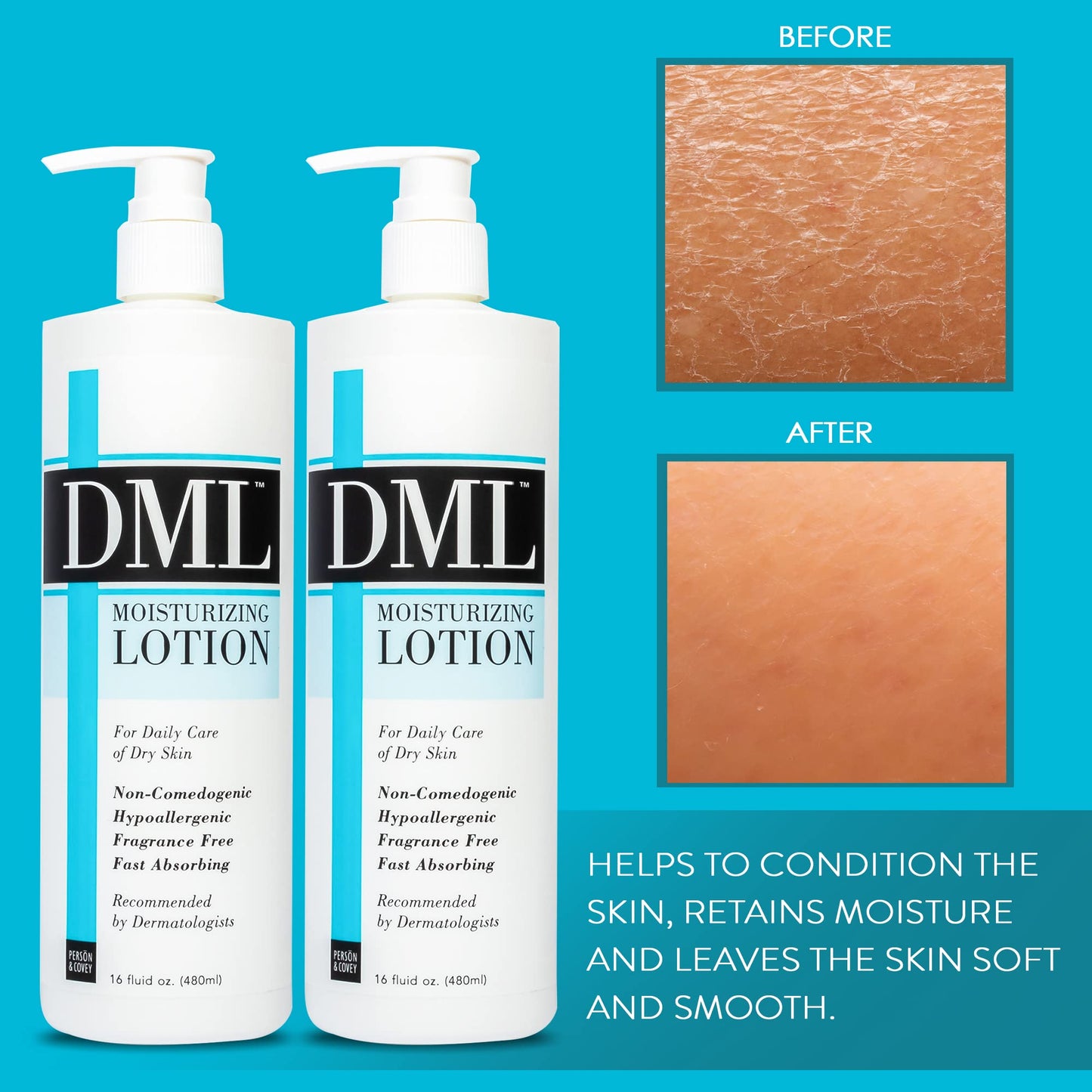 DML Moisturizing Lotion- Hydrating Hand and Body Moisturizer / Hypoallergenic Body Lotion for Dry and Cracked Skin / Gentle, Unscented Moisturizing