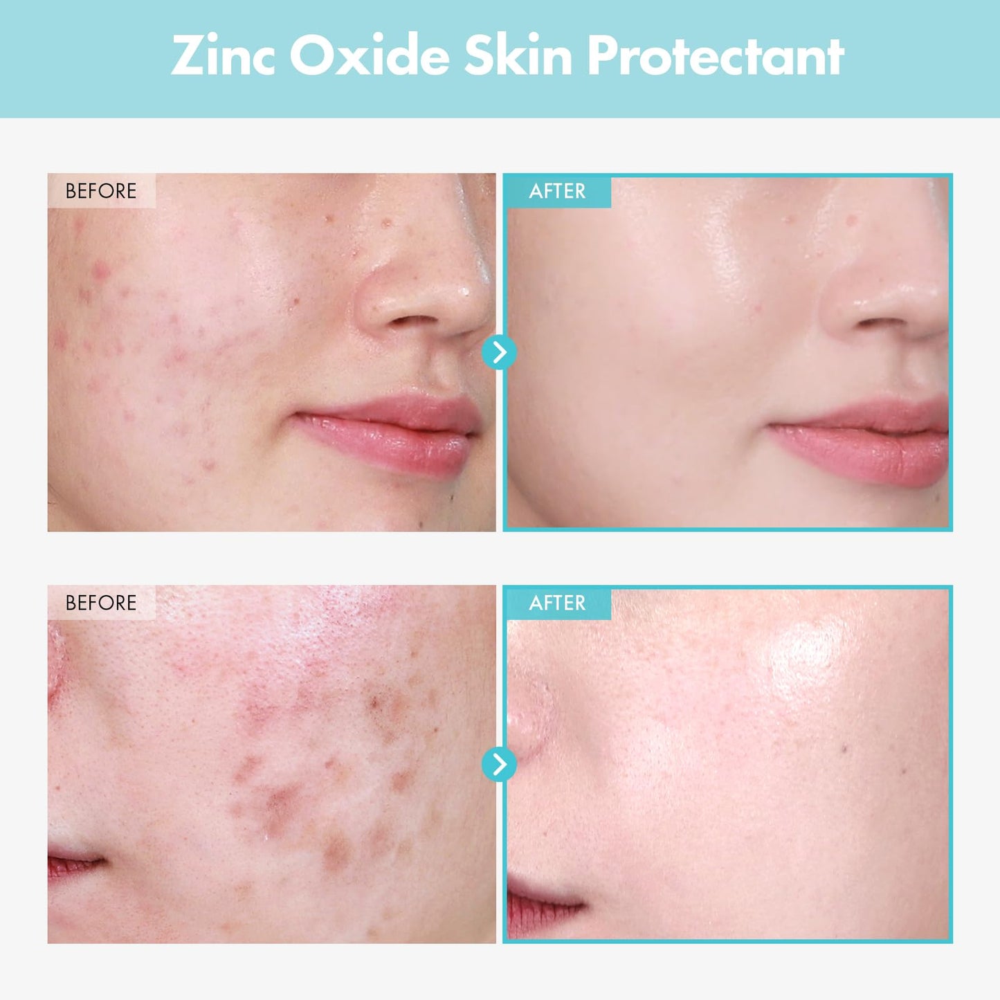 TOSOWOONG Zinc Oxide 10 Cream, 100,000ppm Zinc Oxide, Heal, Soothe Acne, Redness, Rosacea Treatment, Skin Barrier Repair, Moisture, Non-Comedogenic Beauty and Personal Care TOSOWOONG