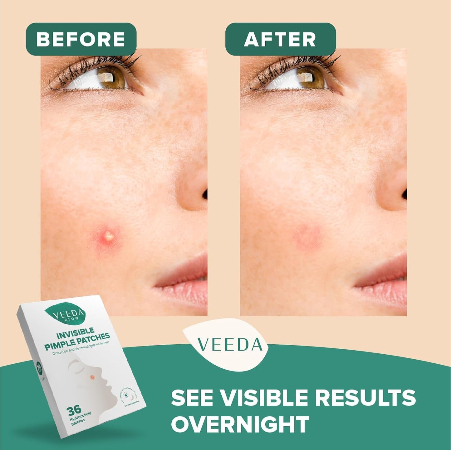 Veeda Glow Pimple Patches - Hydrocolloid Acne Stickers for Fast Healing, Invisible & Non-Irritating Zit Covers, Blemish Spot Treatment, 36 Count