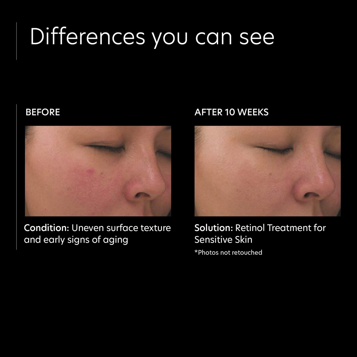 PCA SKIN Retinol Treatment for Sensitive Skin - Anti Aging Face Serum to Gently Reduce Redness & Minimize Fine Lines & Wrinkles - Contains Vitamin A