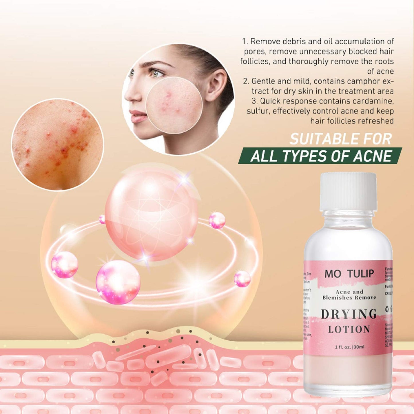 MO TULIP Acne Drying Lotion, Overnight Acne Acid and Acne Spot Treatment for Face and Body, Pimple Lotion Spot Treatment, Dry Out Pimples, Blemishes