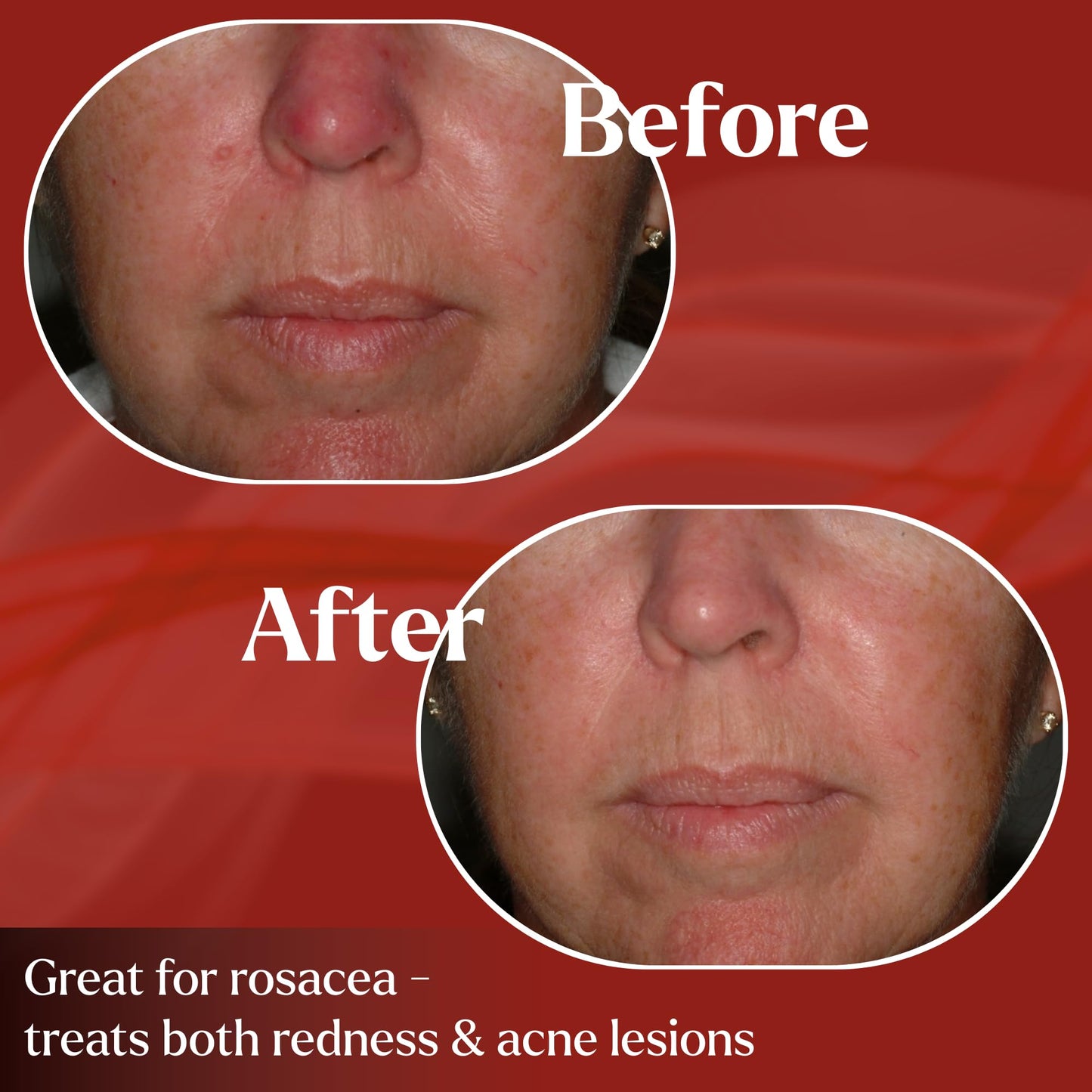 PyratineXR Crème - Antiaging & Rosacea Treatment - Ultimate Cytokinin Skin Cream Reduces Facial Redness, Acne Lesions, Spider Veins, Fine Lines