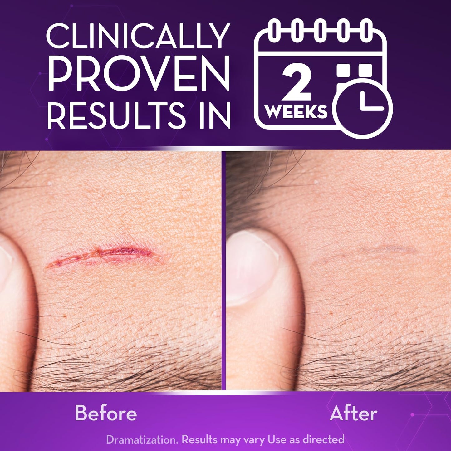 Cicatricure Advanced Scar Gel for Face & Body - Proven Results in 2 Weeks, Scar Treatment for Surgical Scars, Stretch Marks, Scars of Burns