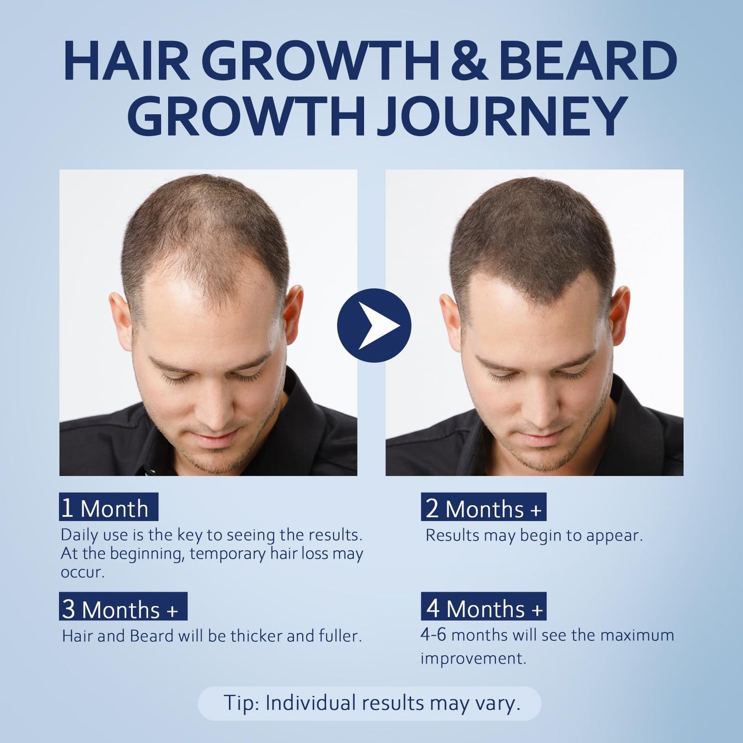 Minoxidil for Men Liquid Solution, Minoxidil for Women Hair Growth Serum, 5% Minoxidil Serum 1PCS for Stronger Roots & Thicker, Fuller Hair, 60ml Beauty and Personal Care Artimore