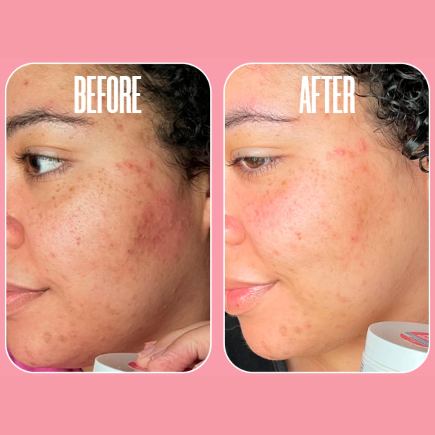 Glycolic Acid Pads with Vitamin C - Toner Pads for Face Cleansing With Tea Tree Oil - Exfoliating Pads with 20% AHA & Vitamins E, B3, B5 - Facial Peel