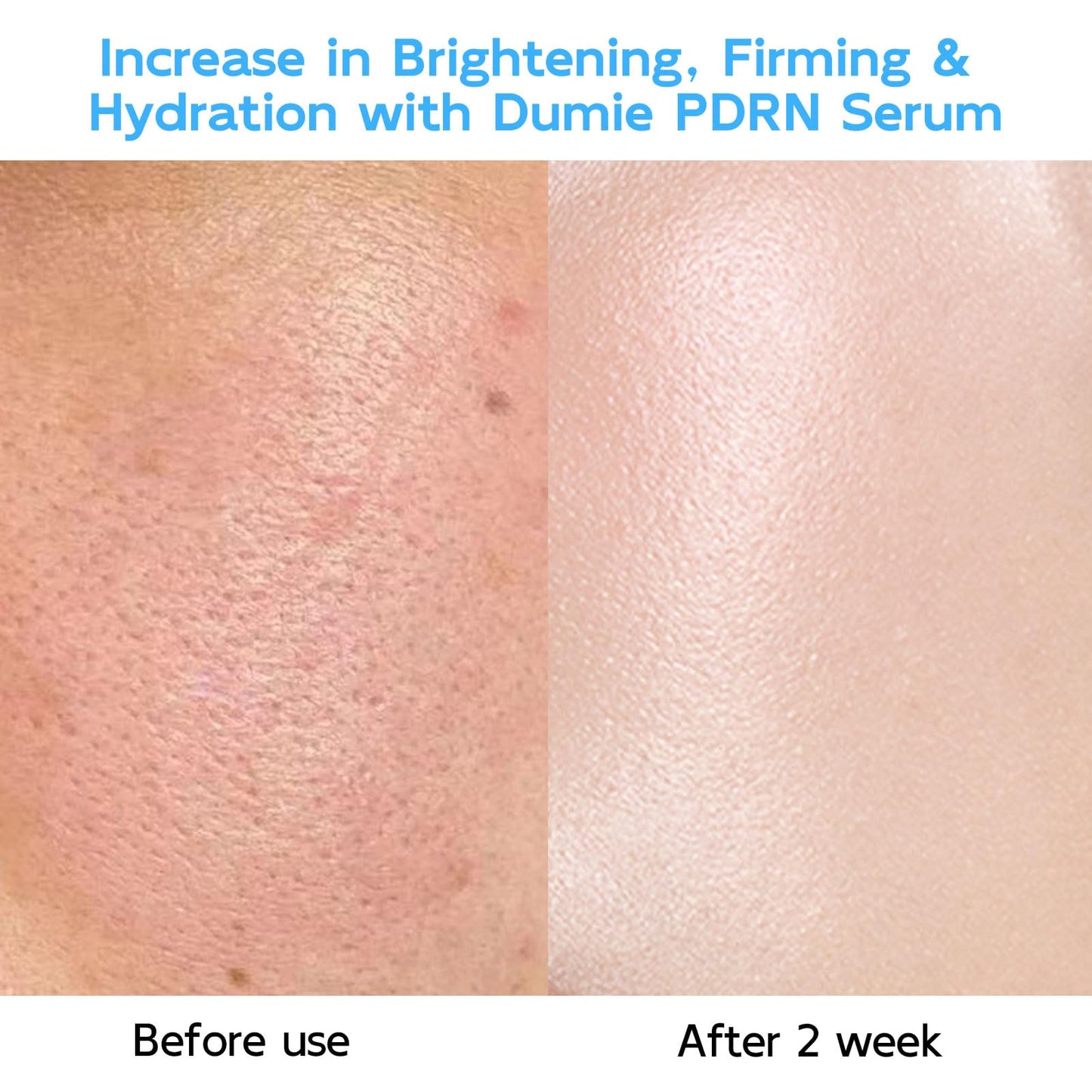 Salmon DNA PDRN Anti-Aging Serum, 5000ppm Salmon Egg DNA Ampoule, 2000ppm Collagen, Glutathione, Niacinamide & 6 Hyaluronic Acids, Korean Skincare