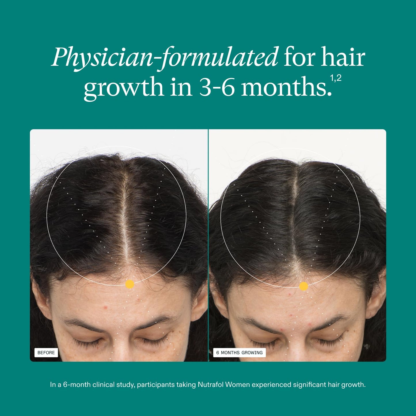 Nutrafol Women's Hair Growth Supplements, Ages 18-44, Clinically Proven for Visibly Thicker and Stronger Hair