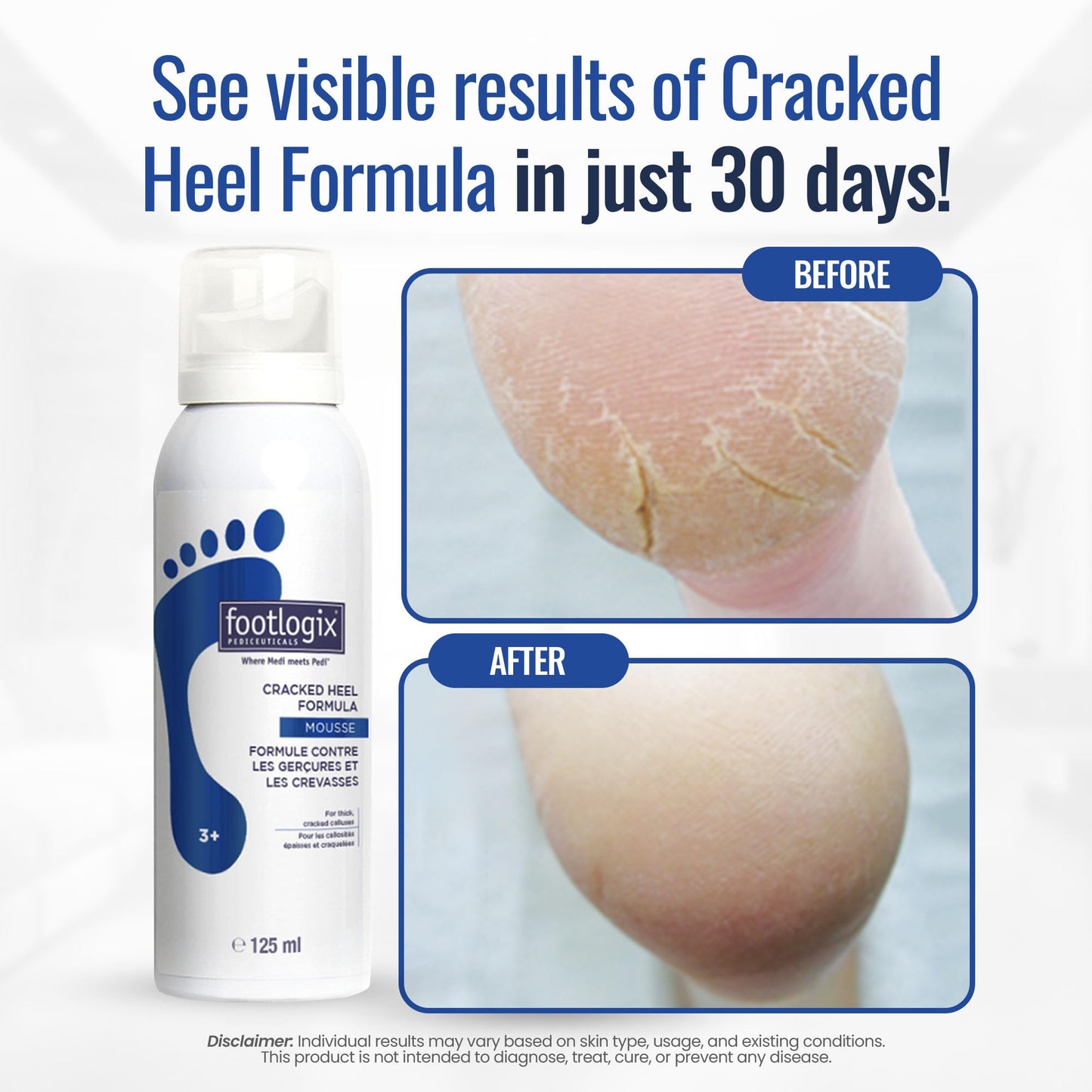 FOOTLOGIX Cracked Heel Formula, White 4.23 Ounce
