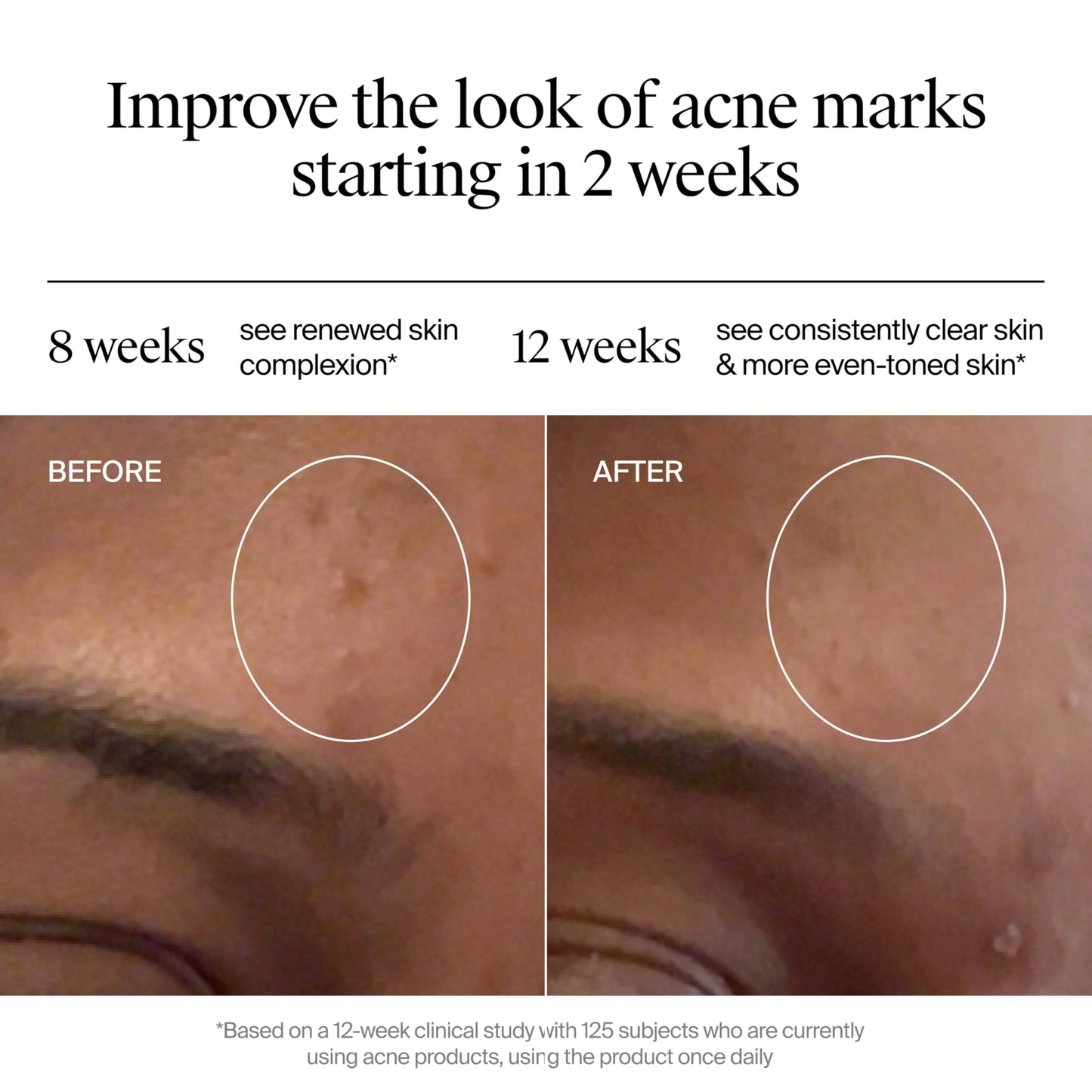 Neutrogena Evenly Clear Retinoid Adapalene Gel 0.1% Acne Spot Treatment, Once-Daily Topical Retinoid Helps Clear Breakouts & Visible Improvement in
