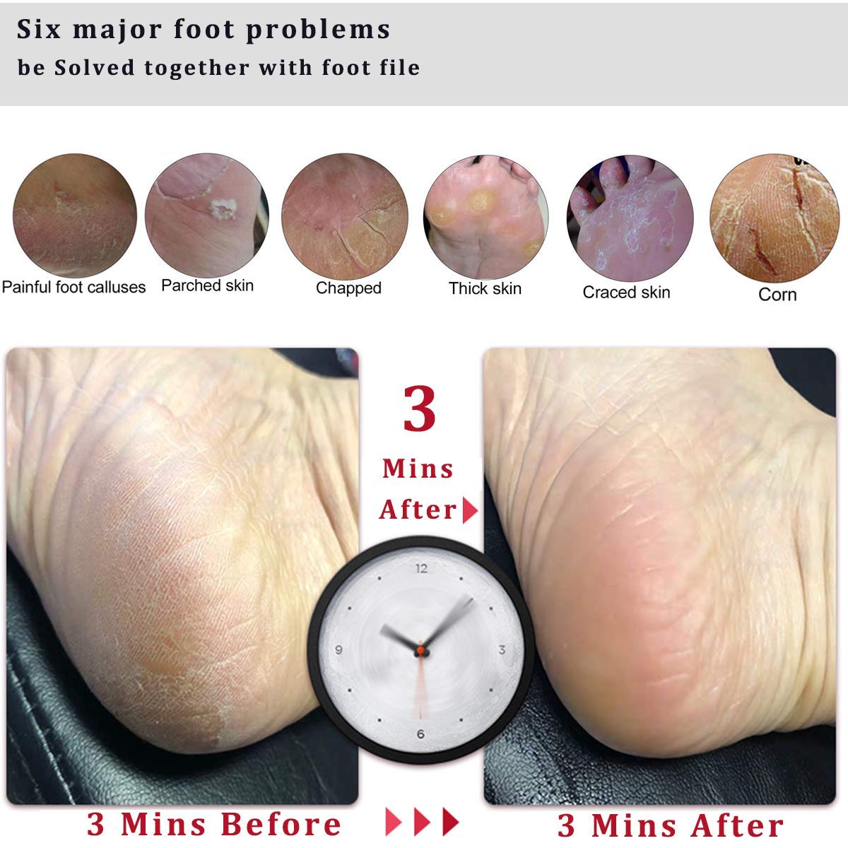 Kinepi Foot File Callus Remover Foot Scrubber,Professional Pedicure Foot Rasp Removes Cracked Heels,Dead Skin,Corn,Hard Skin,Pumice Stone for Scraper