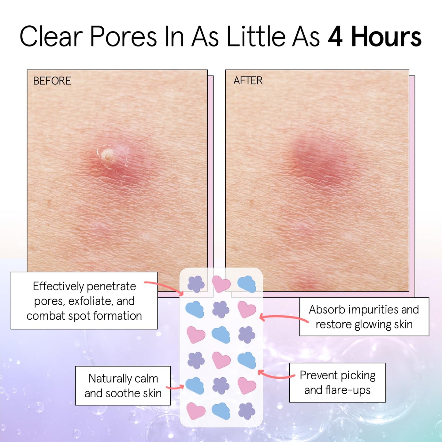 grace & stella Award Winning Pore Strip - Pimple Patches for Face - Hydrocolloid Acne Patches - Absorbs Zits, Reduces Redness - Cute Patches