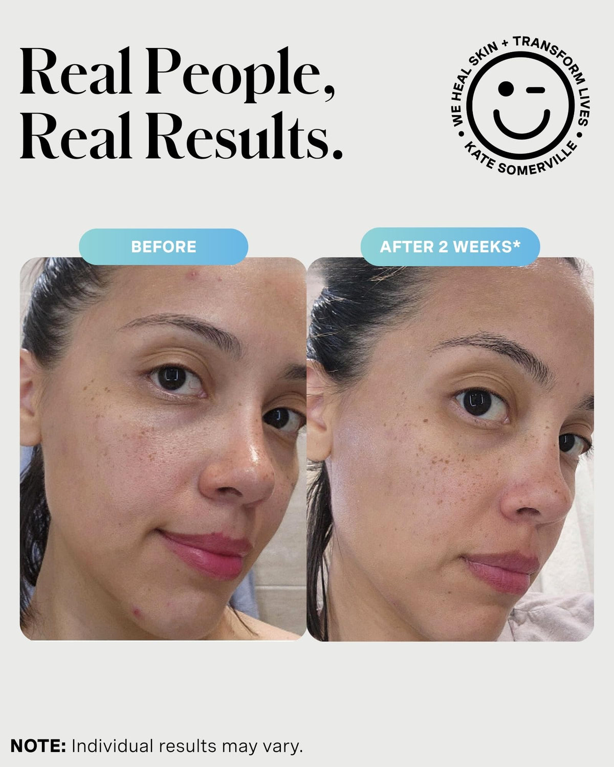 Kate Somerville EradiKate 3% Sulfur Daily Foaming Cleanser Acne Treatment - Clinically Formulated Medicated Face Wash Balances Skin & Cleans Pores, 4 Beauty and Personal Care Kate Somerville