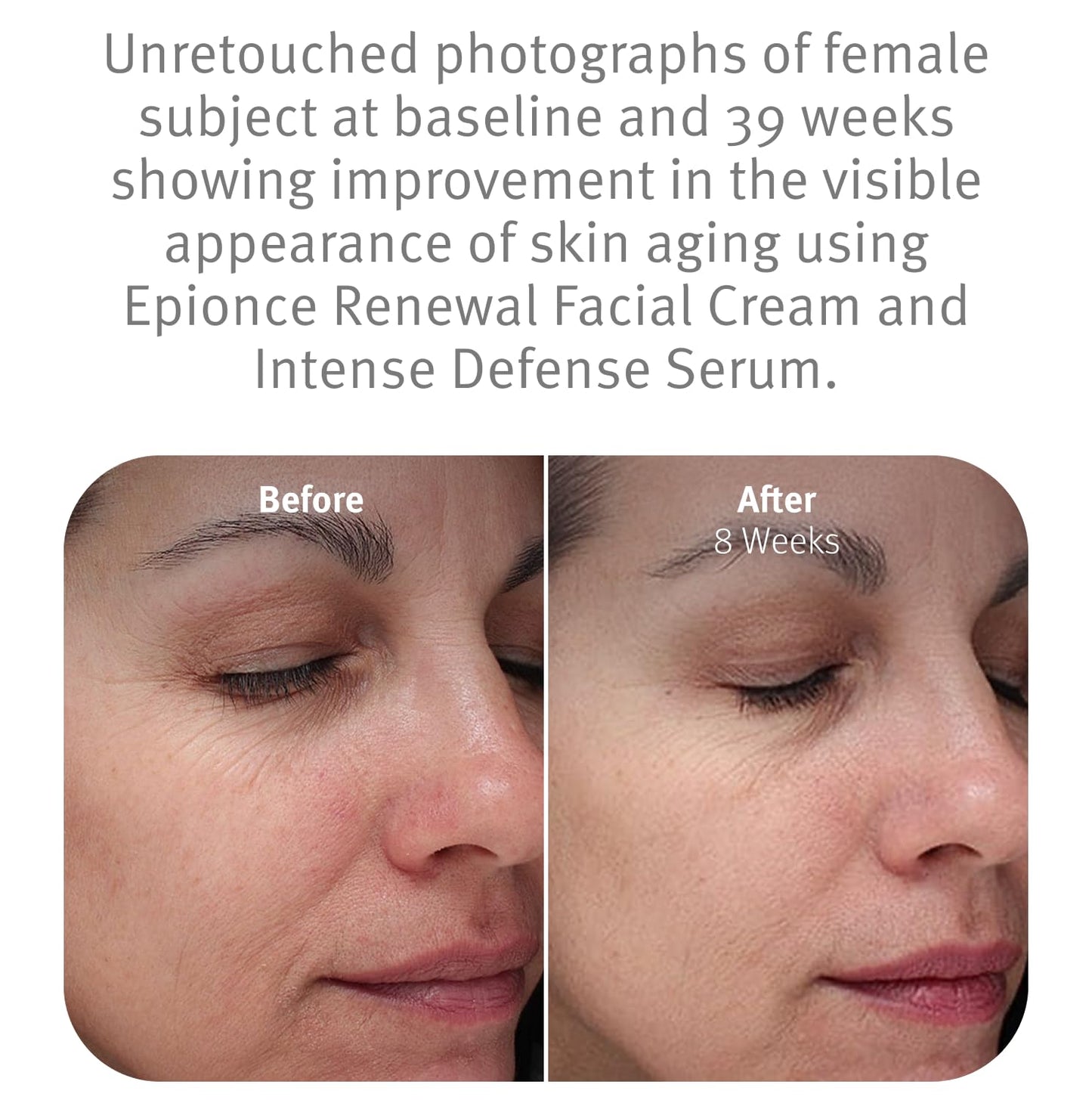 Epionce Renewal Facial Cream - Hydrating Anti-Aging Moisturizer | For Dry, Sensitive to Normal Skin | Fine Lines & Wrinkles | Dermatologist Skincare