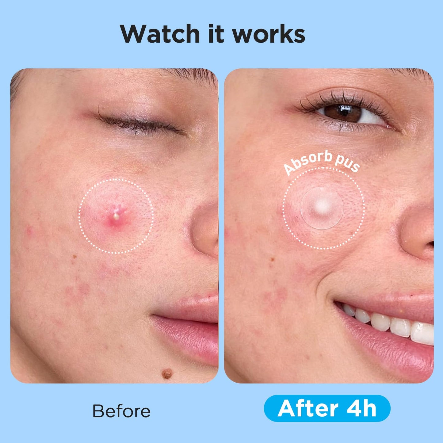 Glowpatch Pimple Patches for Face (504 Count), FSA Eligible Acne Patch Bulk, Zit Stickers 4 Sizes, Hydrocolloid Spot Stickers, Clear Acne Dots Beauty and Personal Care Glowpatch