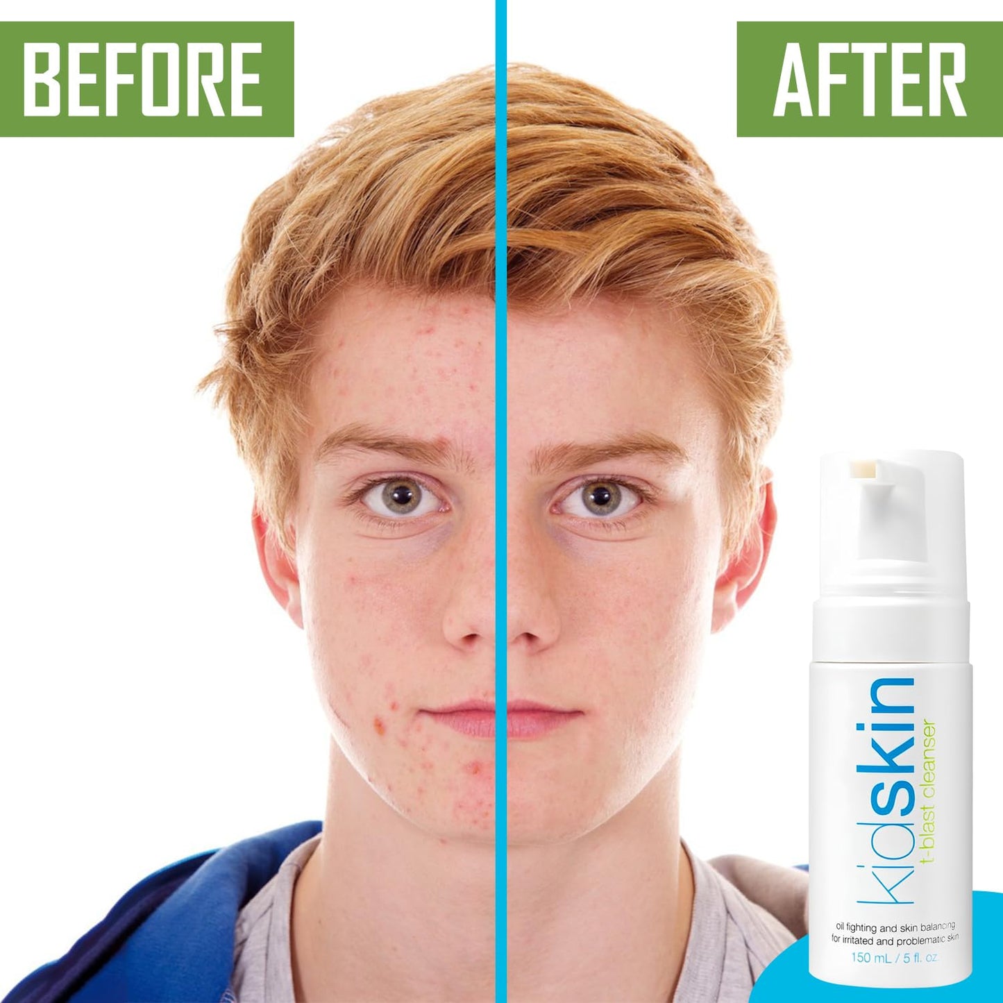 Kidskin T-Blast Facial Cleanser, Gentle Face Wash with Tea Tree Oil, Spot Skin Care for Kids and Teens, Non-Drying Natural Cleanser for Oily or Dry