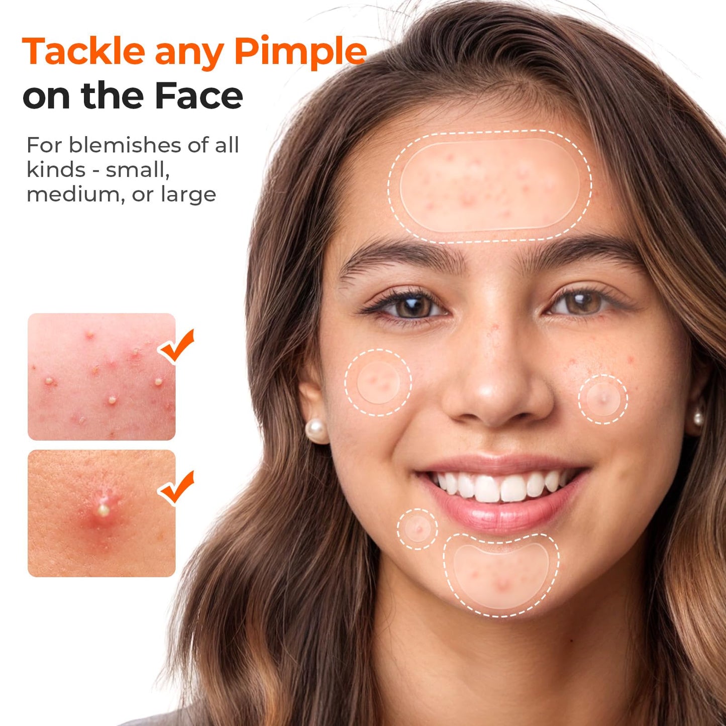 TKTK 443 Count Pimple Patches for Face, Hydrocolloid Acne Patch Bulk, Acne Stickers for Covering Cheeks, Forehead, Chin Blemishes Zit Breakouts Beauty and Personal Care TKTK