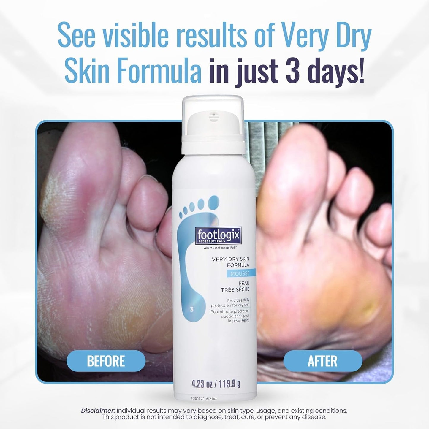 FOOTLOGIX Very Dry Skin Formula Foot Mousse - Urea, Co-Q10, Aloe Vera & Vitamin E | Moisturizing Foot Mousse for Dry & Rough Feet | Fragrance-Free Beauty & Personal Care FOOTLOGIX